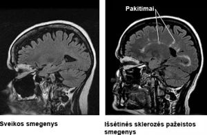 Darbingų ir jaunų žmonių liga – išsėtinė sklerozė